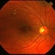 SLE Retinopathy